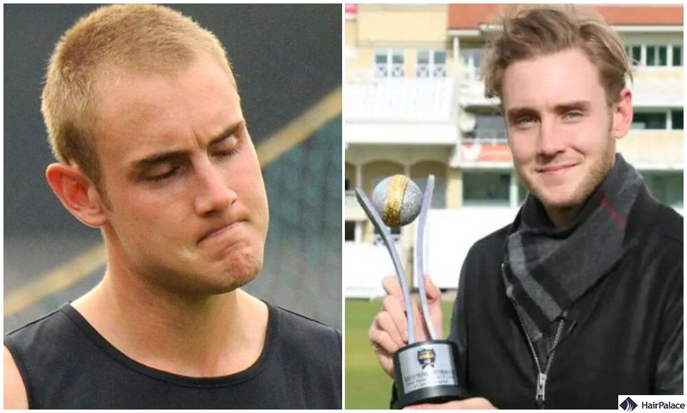 stuart broad hair transplant results before and after